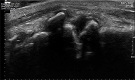 Echografisch beeld van gewrichtsartrose Echografisch beeld van gewrichtsartrose